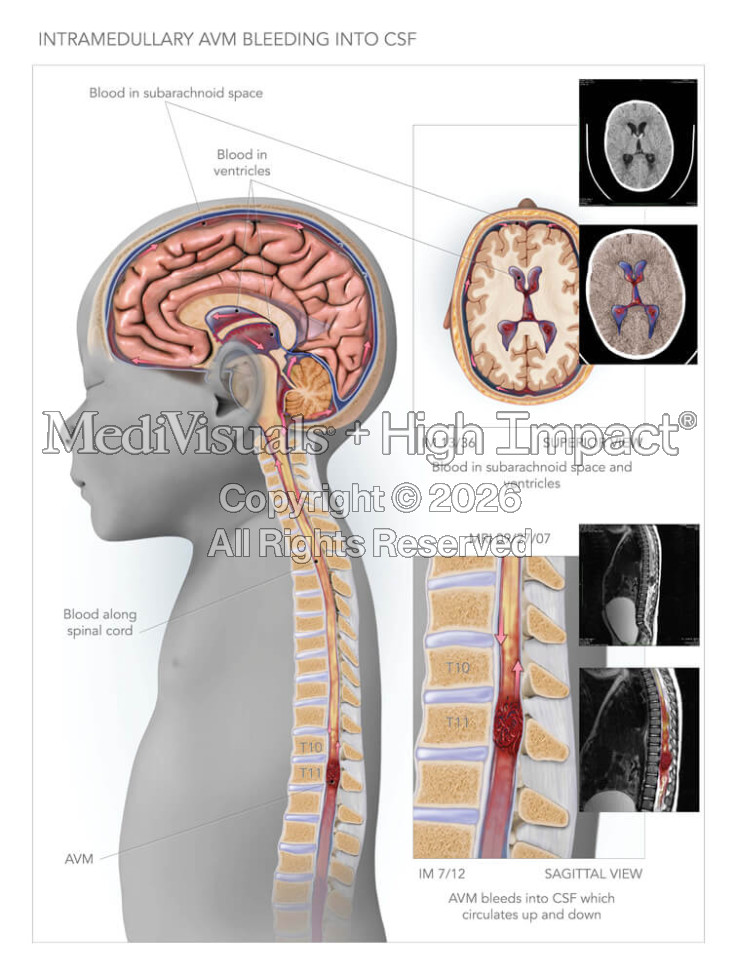 Intramedullary AVM Bleeding into CSF