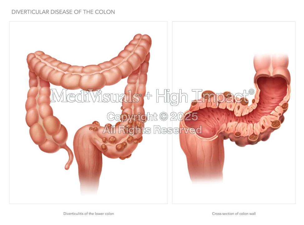 Diverticular Disease of the Colon