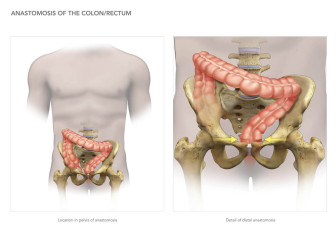 Anastomosis of the Colon/Rectum