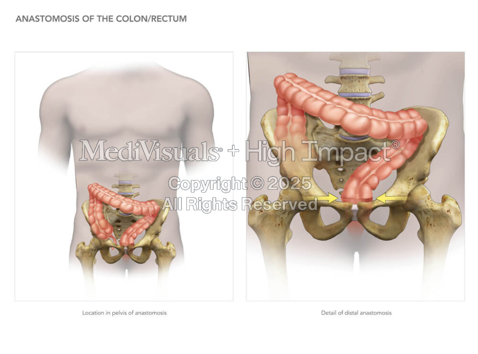 Anastomosis of the Colon/Rectum