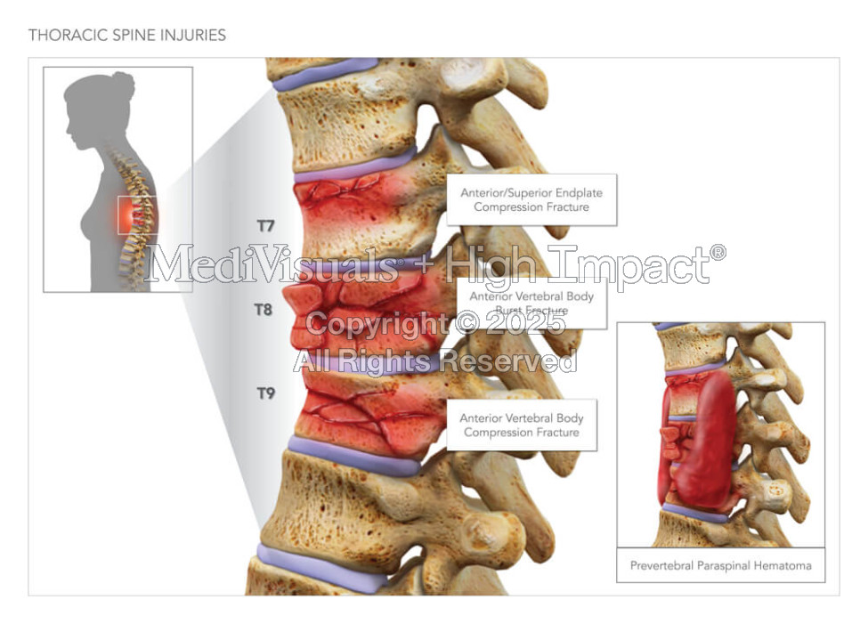 Thoracic Spine Injuries