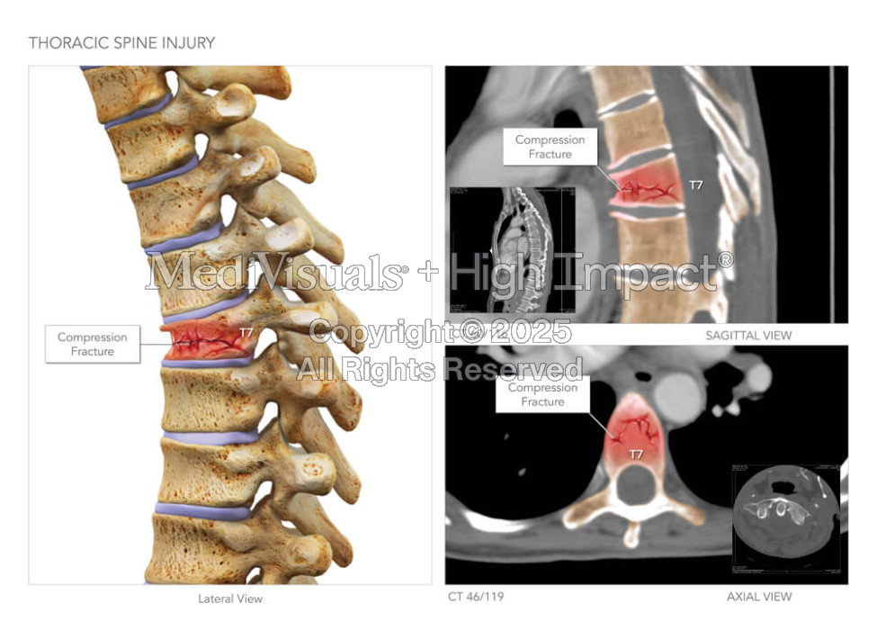 Thoracic Spine Injury