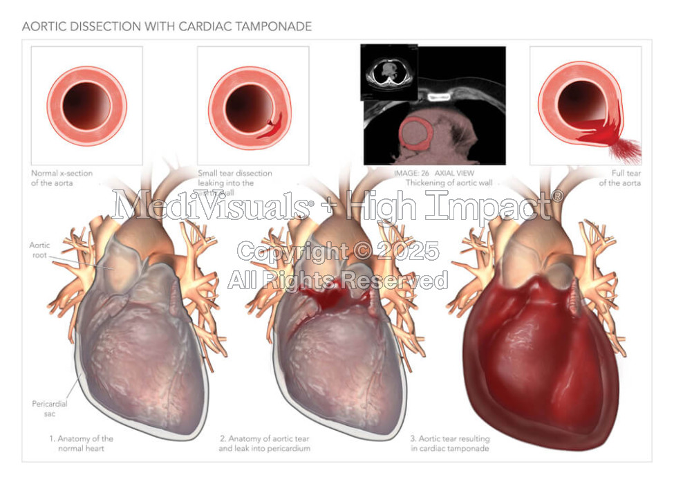 Aortic Dissection with Cardiac Tamponade
