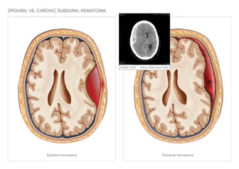 Epidural Vs. Chronic Subdural Hematoma