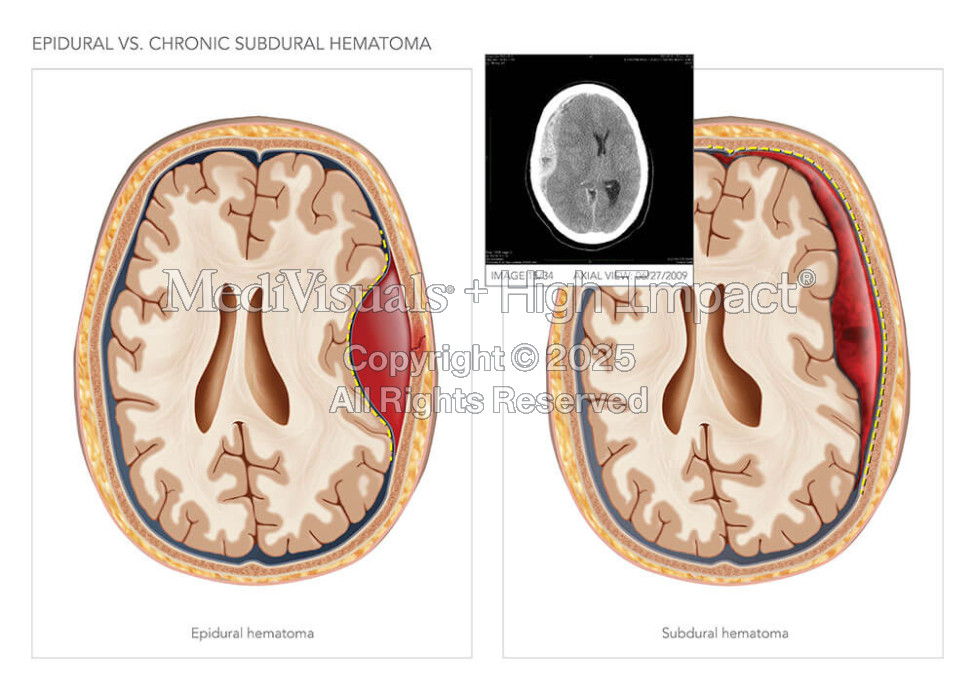 Epidural Vs. Chronic Subdural Hematoma