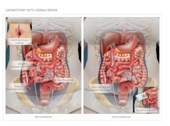 Laparotomy with Hernia Repair