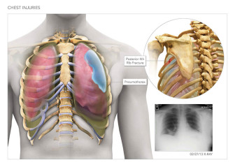 Chest Injuries