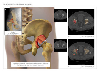 Acetabular Fracture & Repair