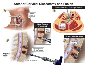 Anterior Discectomy and Cervical Fusion Surgery