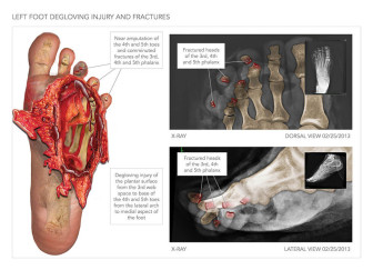 Degloving Injury to the Foot