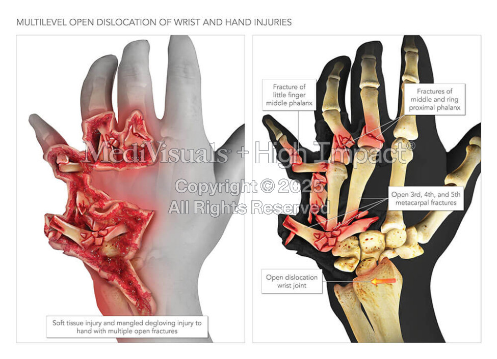 Dislocation of Wrist and Hand with Open Fractures