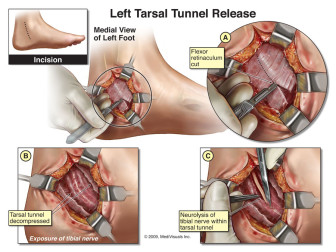 Left Tarsal Tunnel Release
