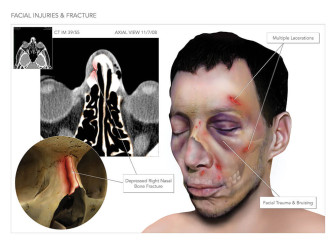 Facial Injuries & Fracture