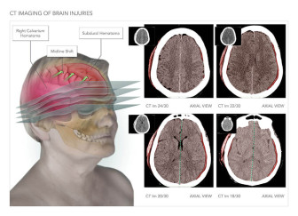 CT Imaging of Brain Injuries