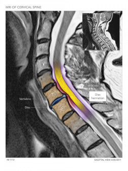 MRI of the Cervical Spine