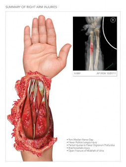 Severe Forearm Injuries