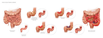 Evolution of Bowel Disease