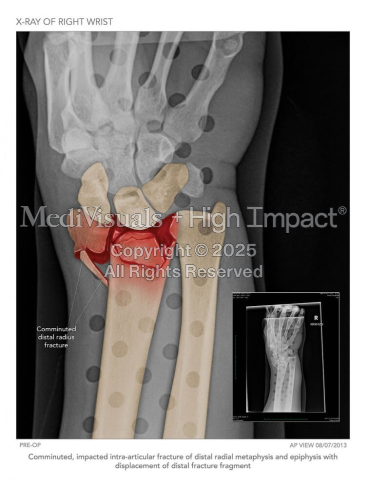 X-Ray of Fractured Wrist