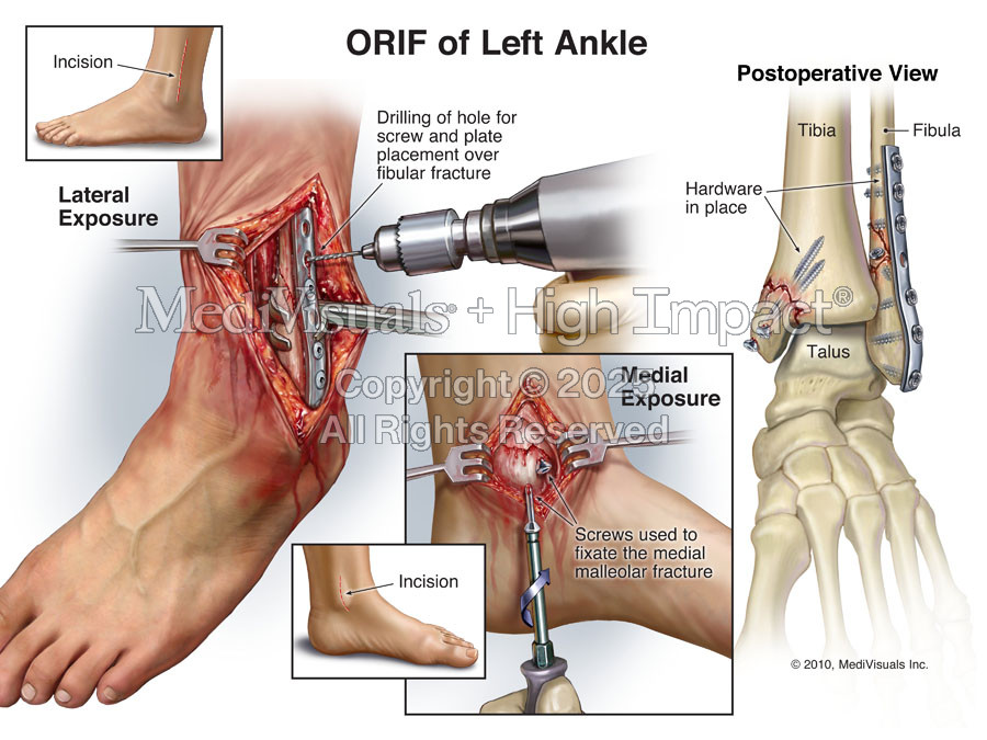 ORIF of Left Ankle