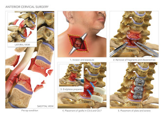 Anterior Cervical Surgery
