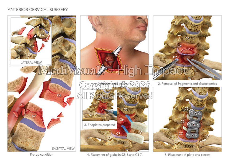 Anterior Cervical Surgery