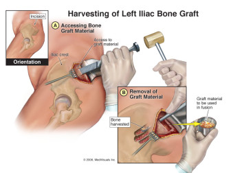 Harvesting of Left Iliac Bone Graft