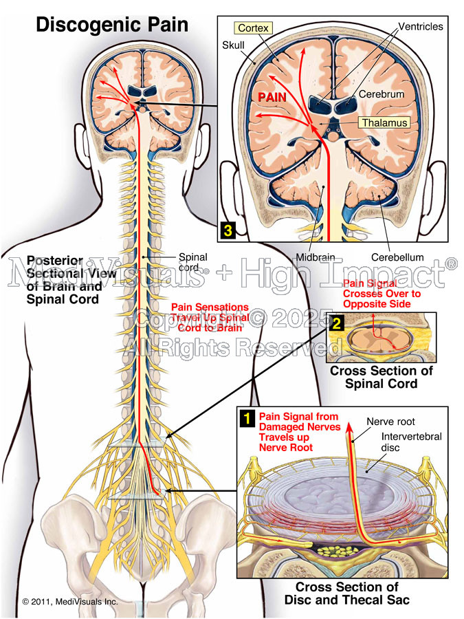 Discogenic Pain