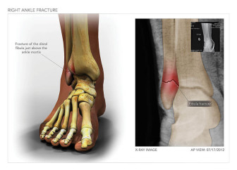 Right Ankle Fracture