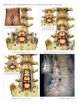 Hardware Removal with L4-5 Fusion