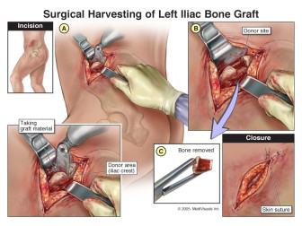 Surgical Harvesting of Left Iliac Bone Crest
