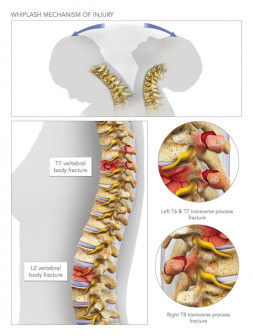 Whiplash Mechanism of Injury