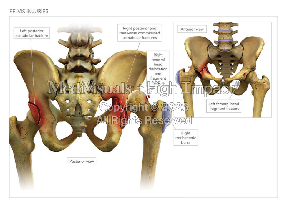 Pelvic Injuries & Fixation