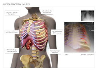 Chest & Abdominal Injuries