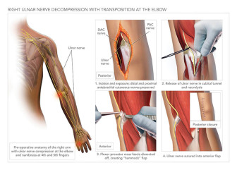 Ulnar Nerve Decompression with Transposition