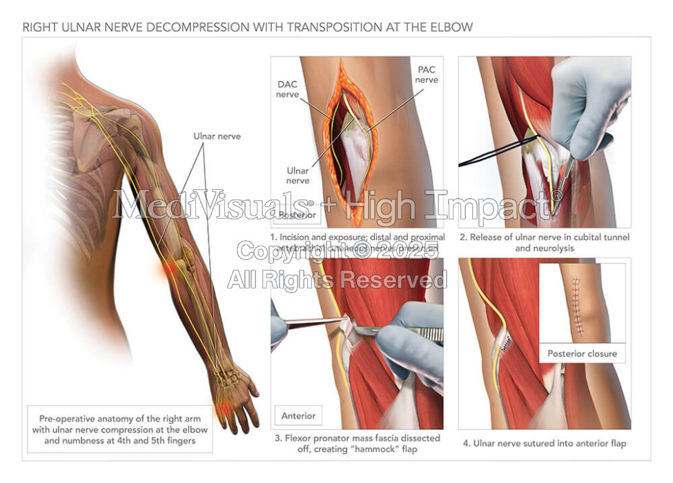 Ulnar Nerve Decompression with Transposition