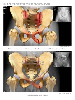 X-Rays of the Pelvis
