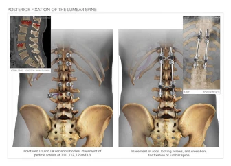 Posterior Fixation of the Lumbar Spine