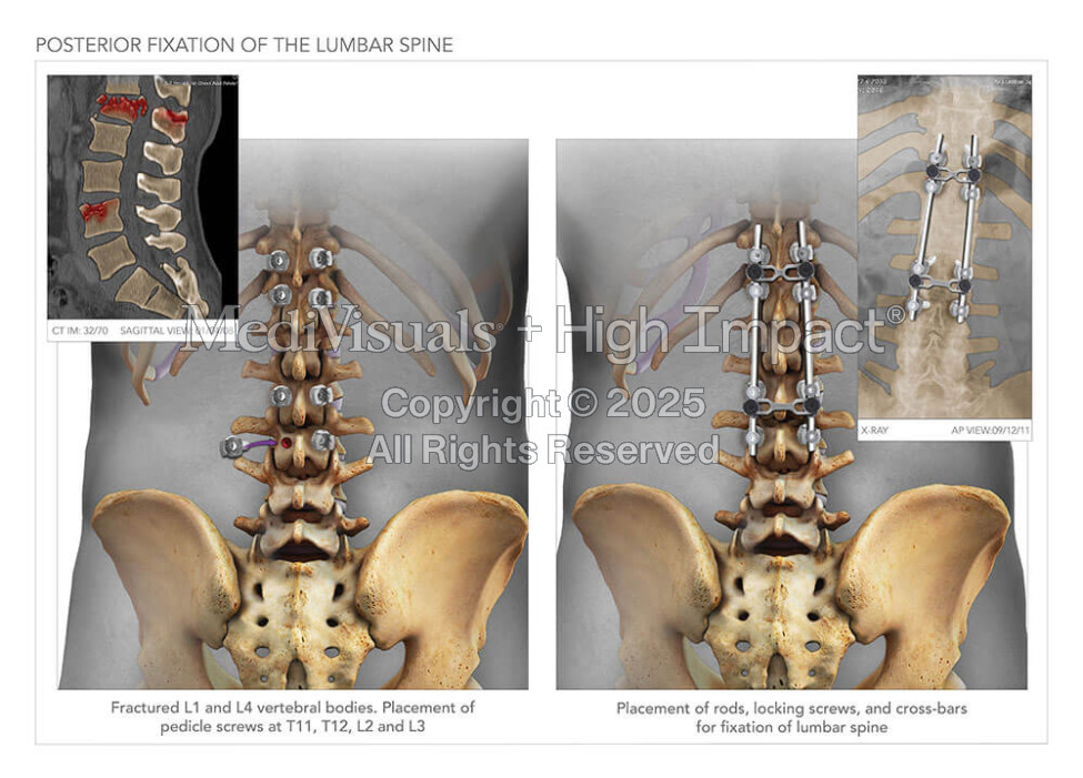 Posterior Fixation of the Lumbar Spine
