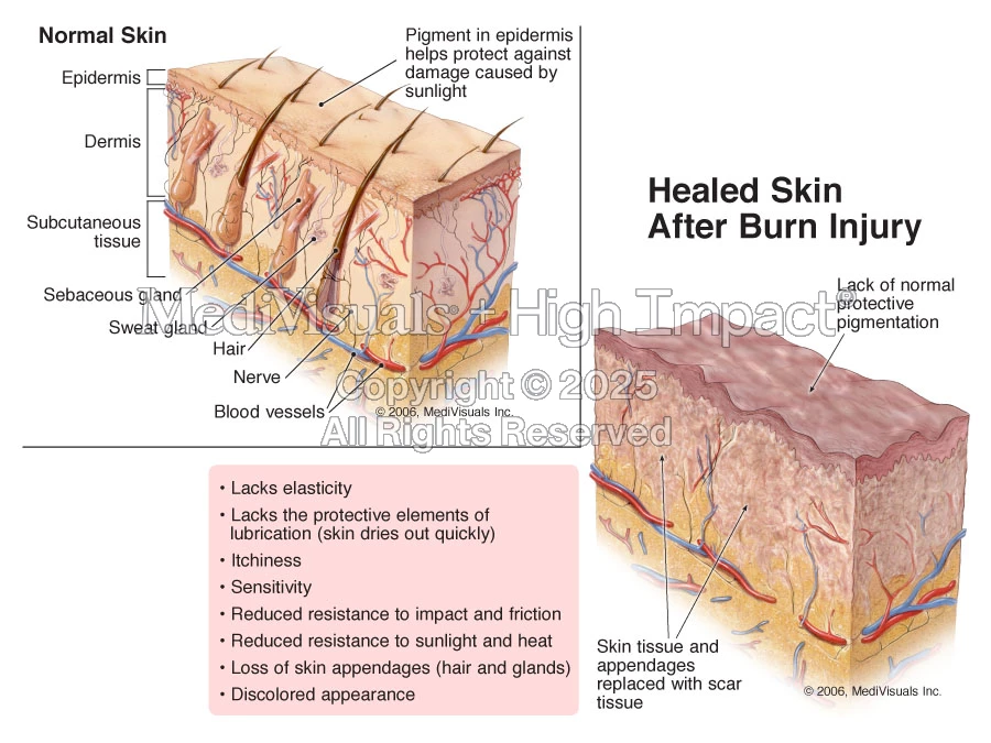 Healed Skin After Burn Injury