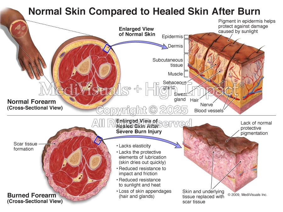 Normal Burn Pattern Skeleton Normal Skin Compared to Healed Skin After Burn