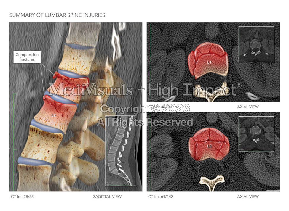 Summary of Lumbar Spine Injuries