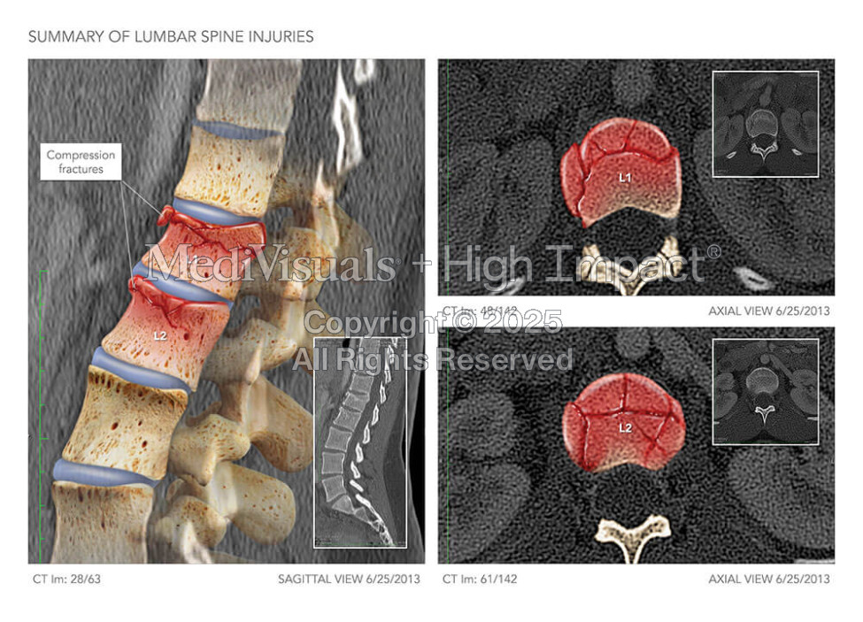 Summary of Lumbar Spine Injuries