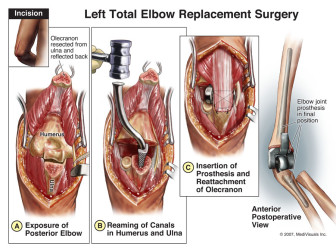 Left Total Elbow Replacement Surgery