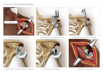 Total Shoulder Reversal