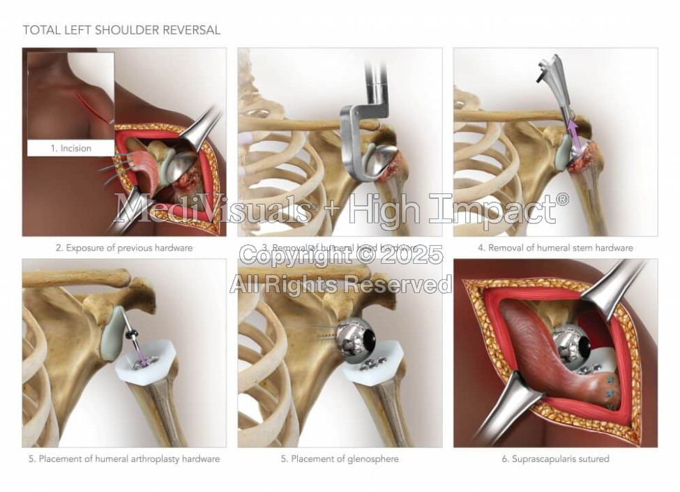 Total Shoulder Reversal