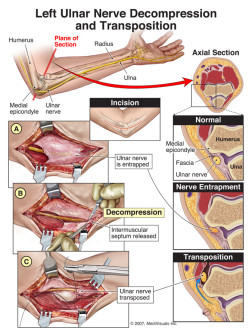 Left Ulnar Nerve Decompression and Transposition