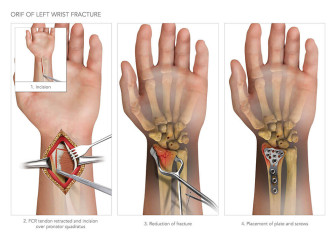 ORIF of Left Wrist Fracture