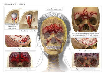 Summary of Injuries