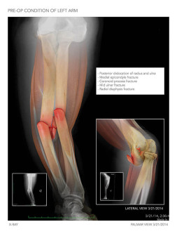 Forearm Fracture and Repair