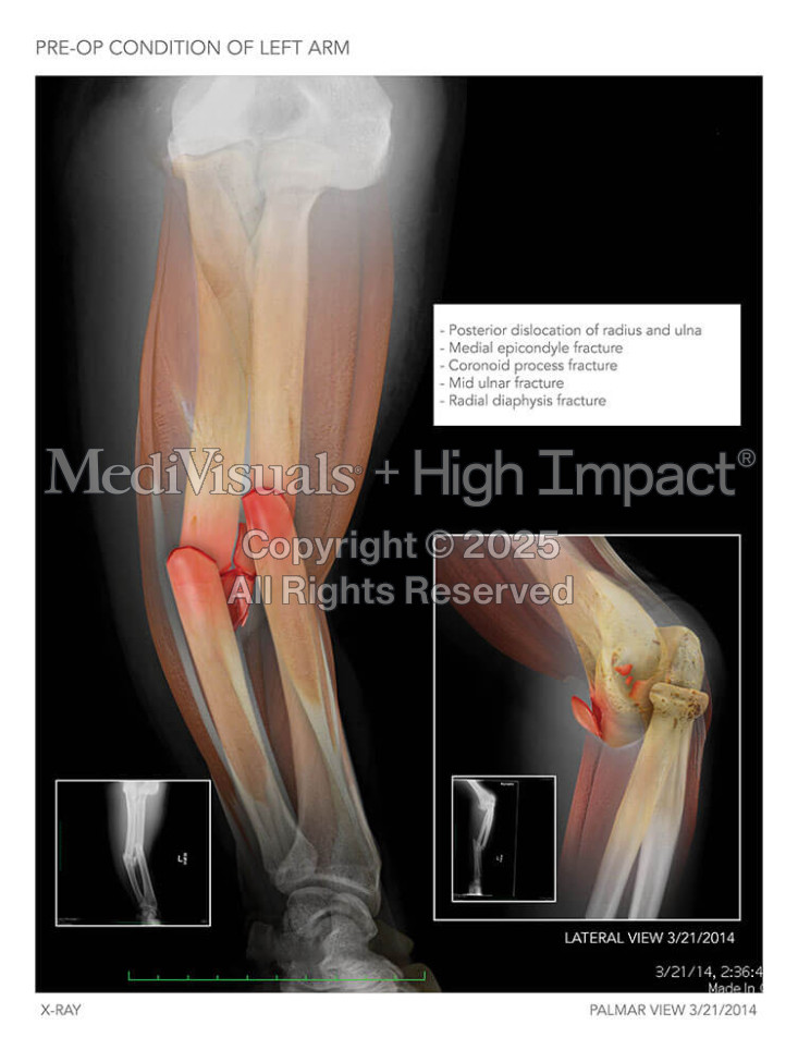 Forearm Fracture and Repair